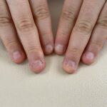 子どもの深爪矯正