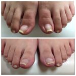 巻爪矯正・痛い巻爪の原因は